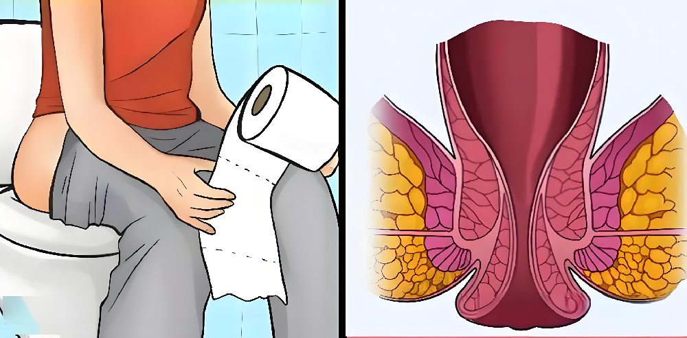 吃辣对肛肠的影响